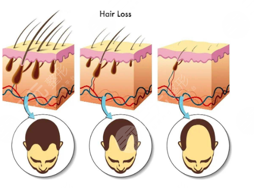秃顶植发能维持多久，有果吗？手术原理讲解，必看干货！