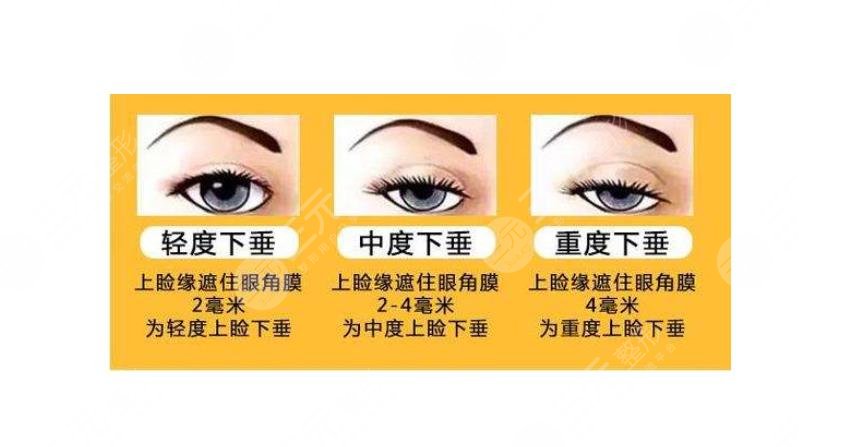 上眼皮松弛下垂做什么有果？提眉好还是全切双眼皮好？美眼攻略~