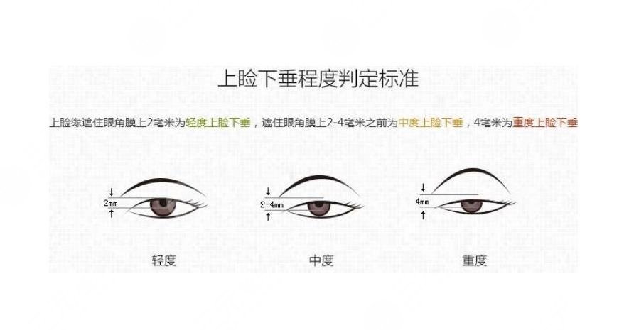上眼皮松弛下垂做什么有果？提眉好还是全切双眼皮好？美眼攻略~
