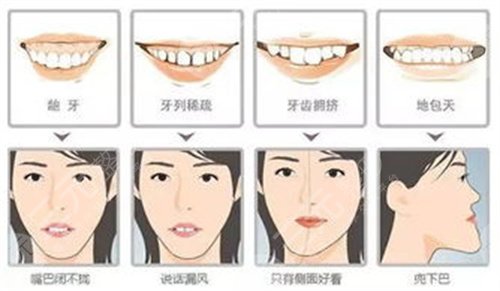 牙齿矫正案例