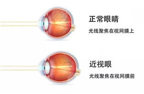 北京近视手术