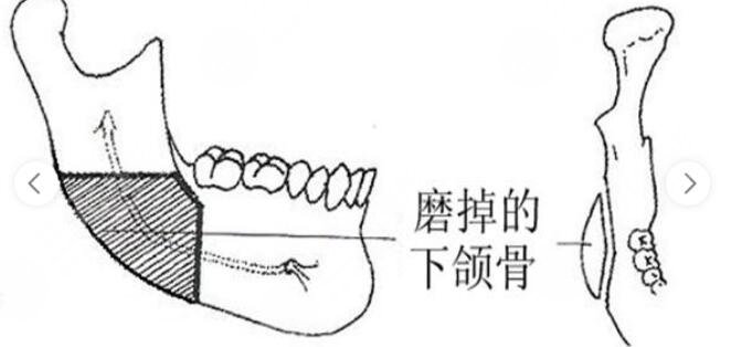 上海华美下颌角案例