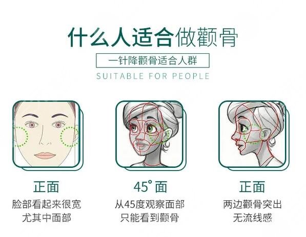 颧骨整形