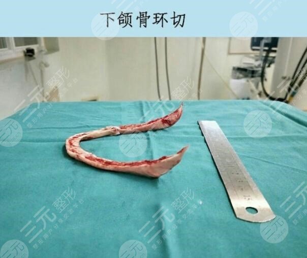下颌角磨骨