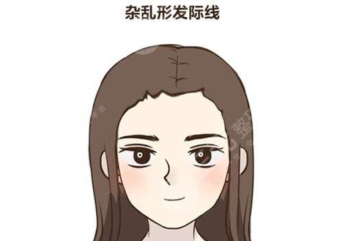 纹发际线和植发哪个好？原理科普+利弊分析，挑选指南！