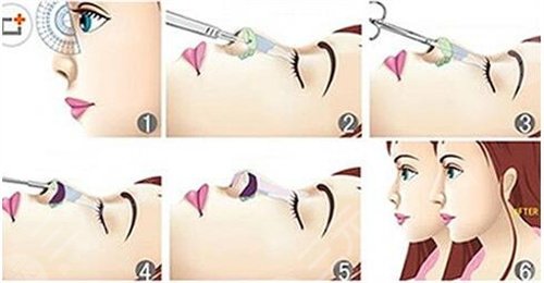 赵延勇隆鼻案例