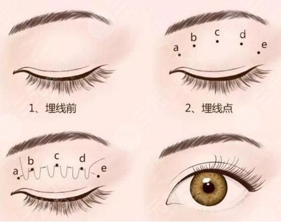 全新整形价格表分享|韩式开眼角手术三点双眼皮真实记录