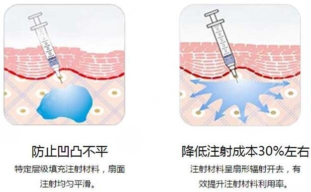 北京玻尿酸去除法令纹多少钱