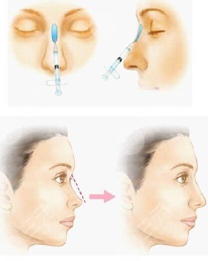 北京玻尿酸去除法令纹多少钱