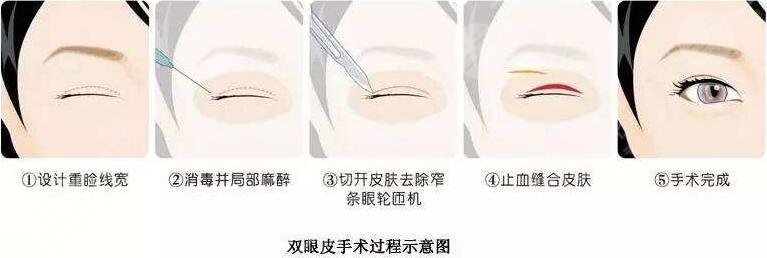 北京美容院割双眼皮多少钱