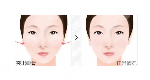 抽脂瘦脸手术案例术后1周