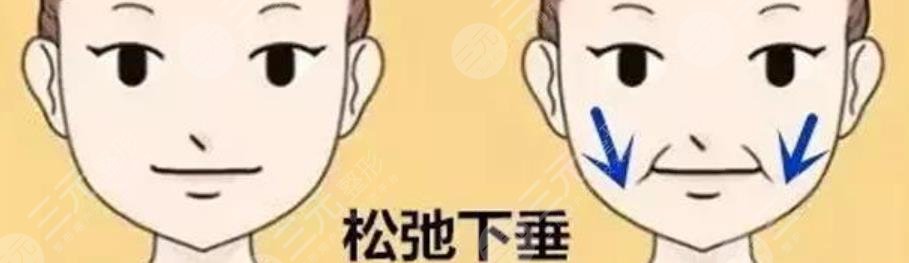 下颌缘吸脂