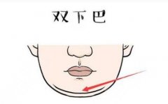 双下巴吸脂对比果图文讲解!术后如何护理?超贴心塑颜指南! 双下巴吸脂对比果图文讲解!术后如何护理?超贴心塑颜指南!