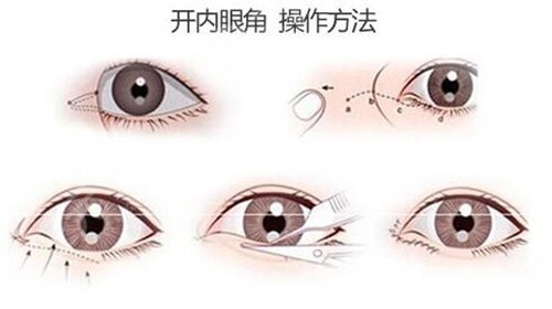 开眼角手术果