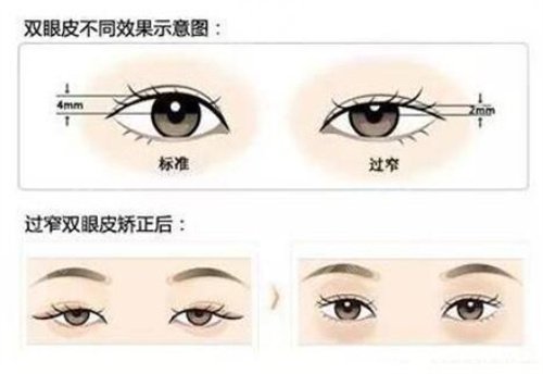 上海第九人民医院双眼皮手术案例