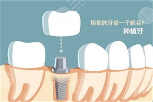 重庆美奥口腔医院种植牙经历分享