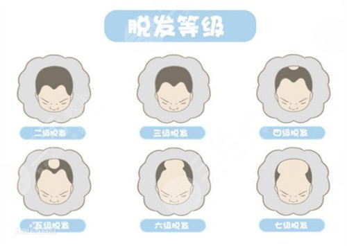 上海九院植发手术经历