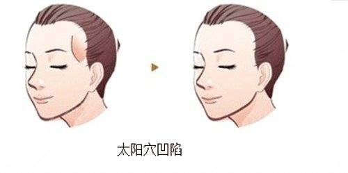 自体脂肪丰太阳穴果好不好？优缺点+果图分享！
