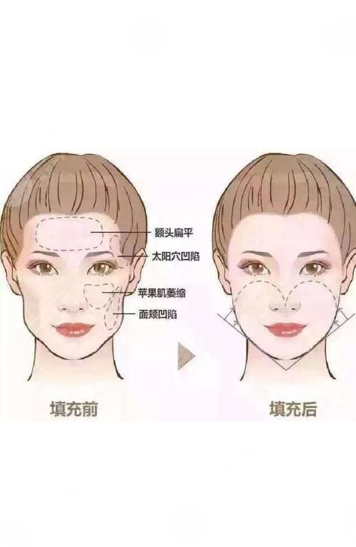 面部填充手术费用多少钱？价格表分析&果图分享，值得！