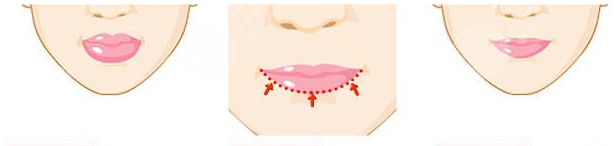 厚嘴唇整形手术缓解 嘴唇整形手术果图