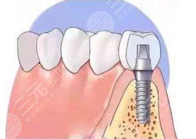 种植牙注意事项有哪些?