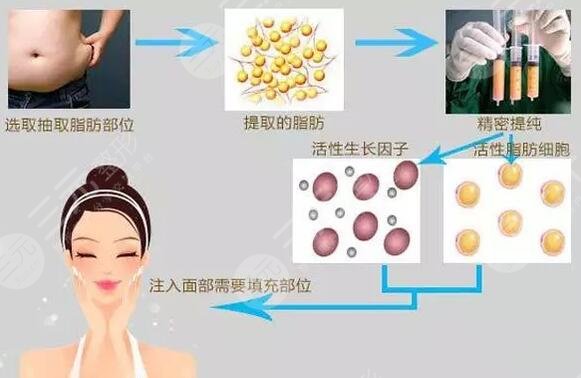 我的自体脂肪面部填充经历,持续中???