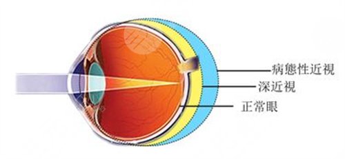 香港大学深圳医院眼科怎么样?近视全飞秒案例