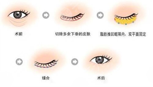 汉中卓美整形医院去眼袋案例