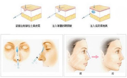 注射除皱注射术后