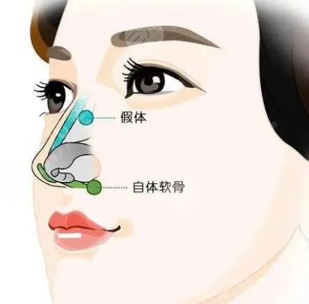 硅胶隆鼻手术