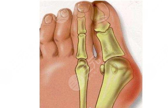 大脚骨需不需要做手术