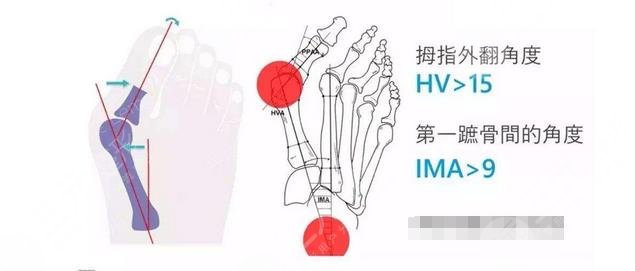 产生大脚骨的因素是什么