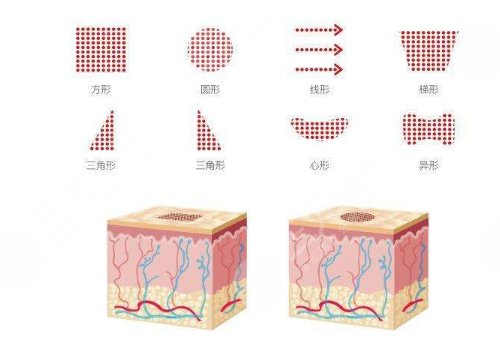 点阵激光多少钱一次?能去凹陷疤吗?作用和功盘点!