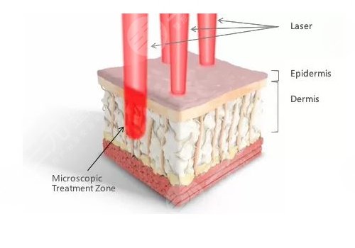 点阵激光能够去凹陷疤吗?作用和功