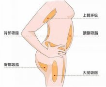 抽脂形体改良怎么做?一个月真实案例恢复果分享