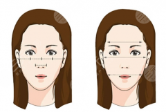 面部埋埋提升真实案例分享：十五天轻松换回少女姿态~