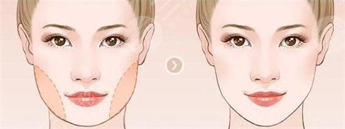 颊脂垫手术真人案例