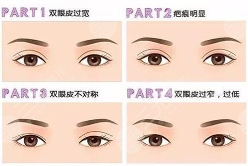 什么是双眼皮多项整形恢复期