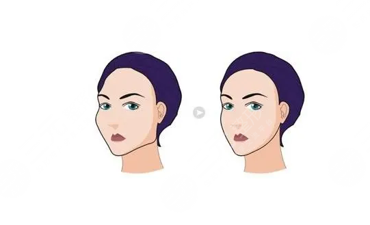 面部轮廓整形