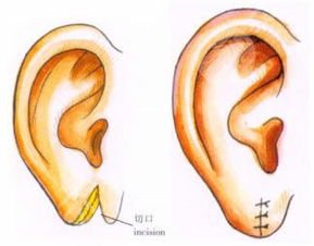 颅耳角在30°-60°之间矫正术后注意事项
