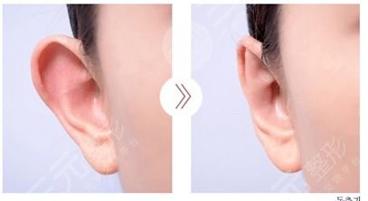 什么是颅耳角在30°-60°之间