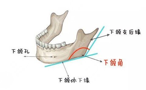 下颌角切除后会不会再次长出来