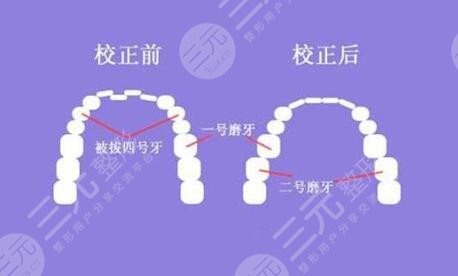 牙齿矫正的方法都包括哪些呢?