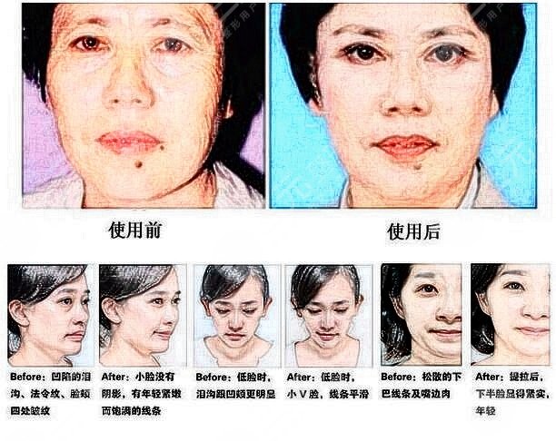 玻尿酸填充法令纹真实案例果图:术前一天