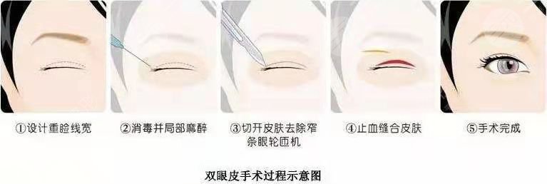 易阳艳割双眼皮手术过程
