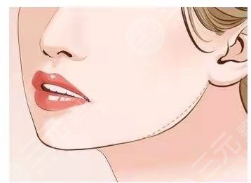 上海九院整形科磨骨手术术后果