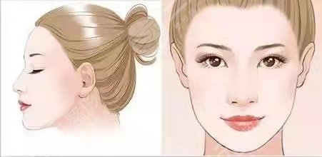 广州张建军医生磨骨手术术后一周