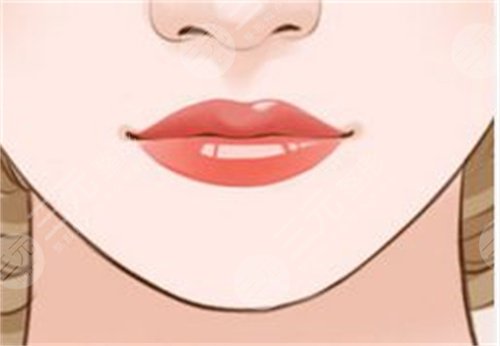 安庆在玻尿酸丰唇改唇大概需要多少钱？这种方式贵吗？