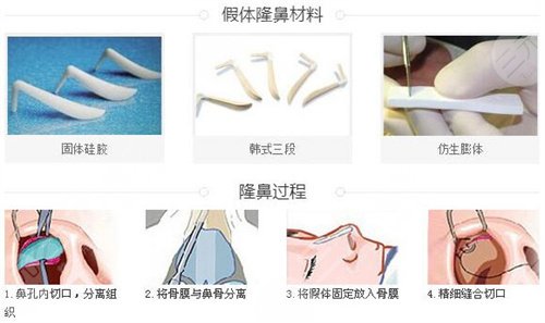 上海隆鼻假体取出费用多少？