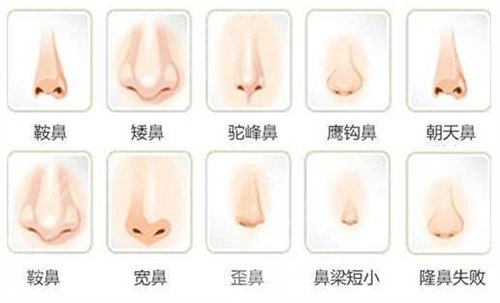 上海隆鼻假体取出费用多少？